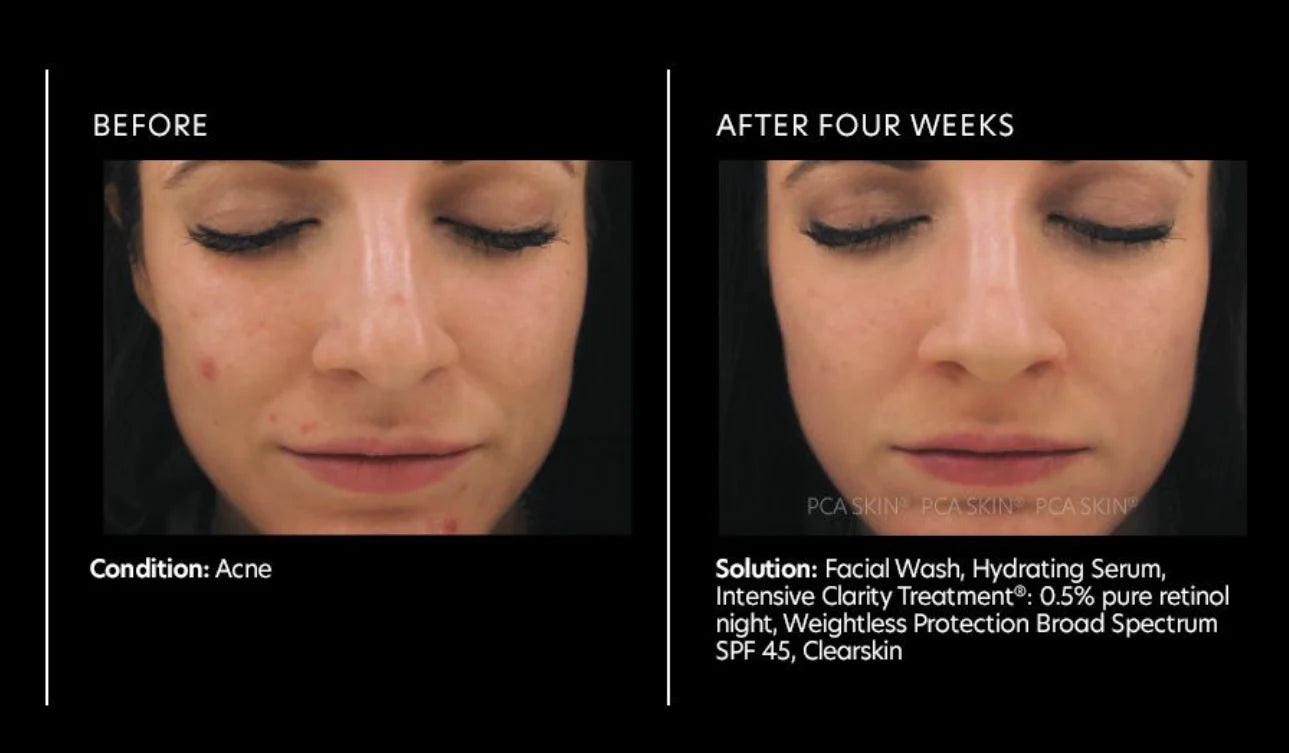 PCA Skin Intensive Clarity Treatment®: 0.5% Pure Retinol Night 29.5g