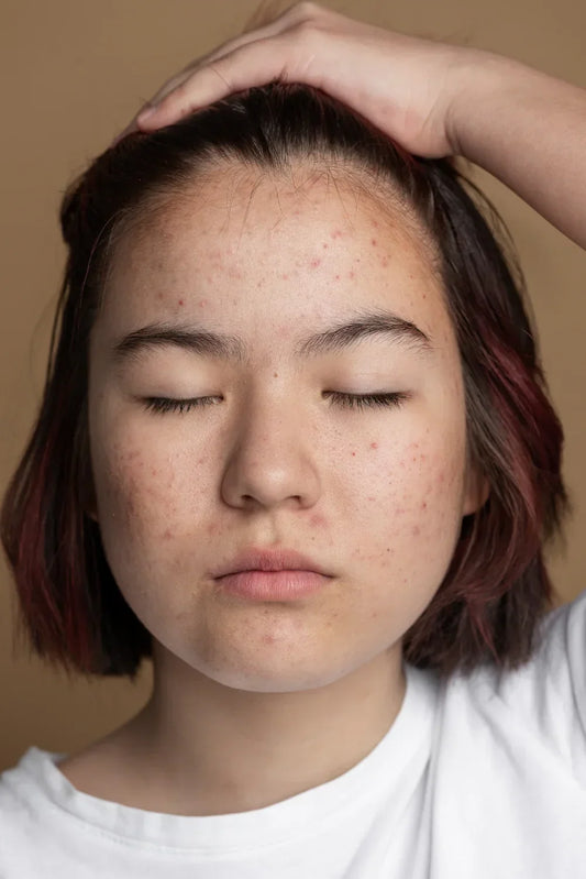 Woman with acne-prone skin touching her forehead, illustrating how to treat acne