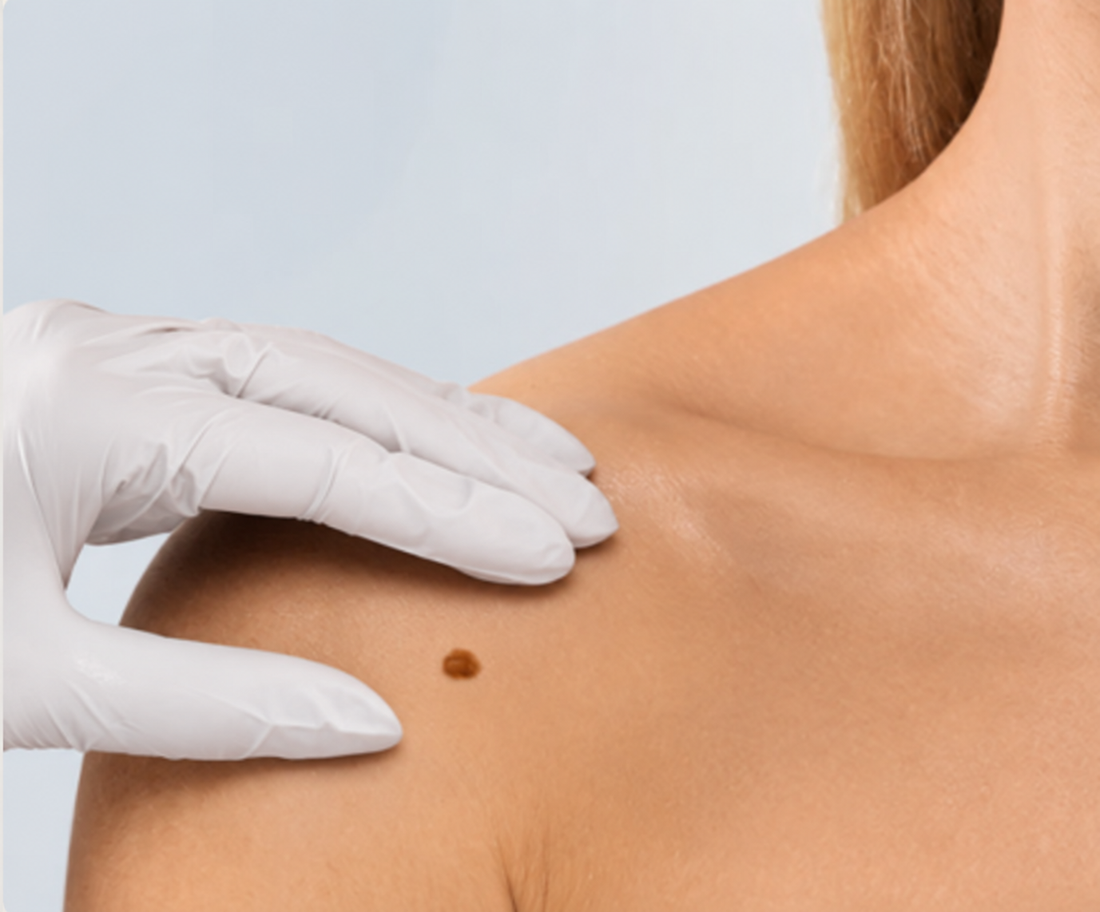 How to check your moles at home, and when to get them looked at