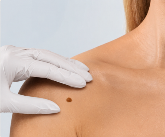 How to check your moles at home, and when to get them looked at