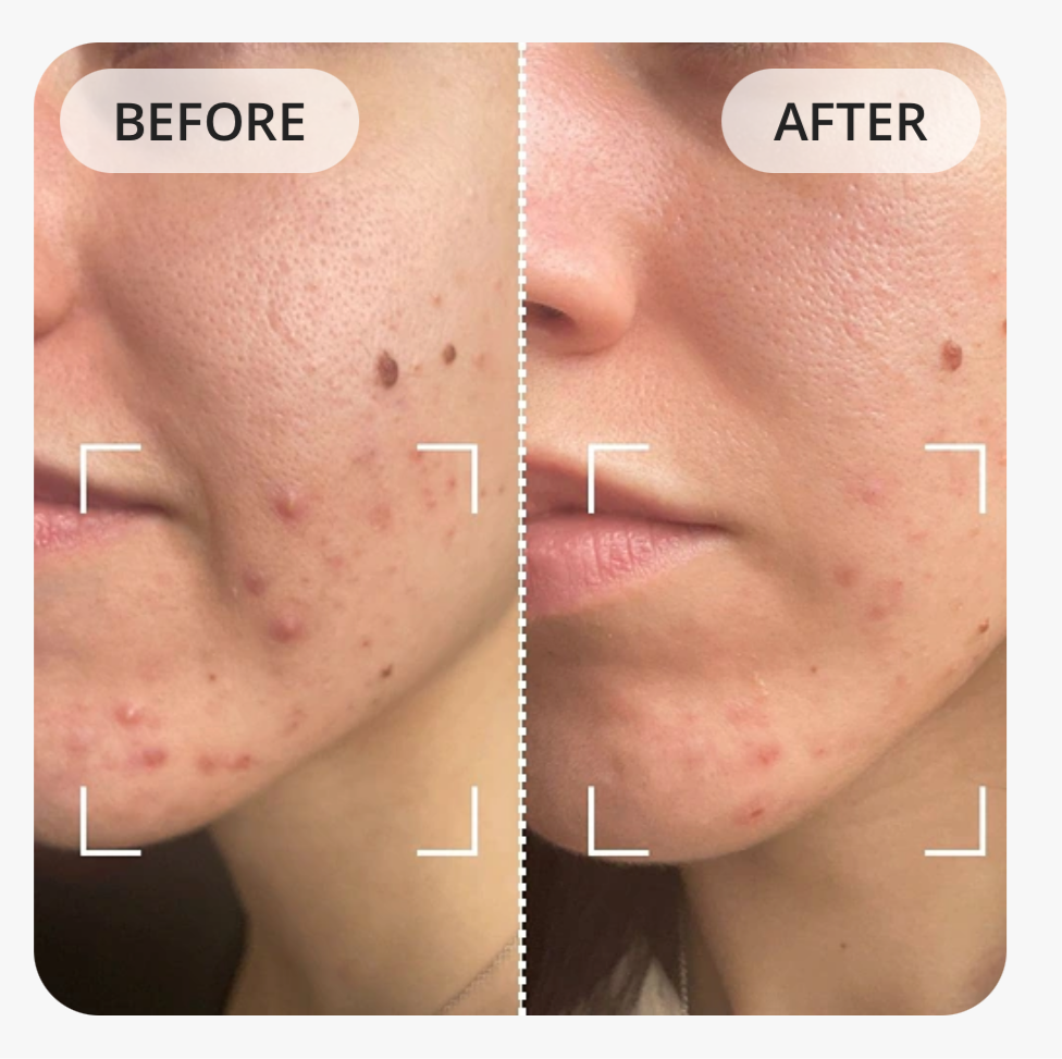 Current Body LED Anti-Blemish Mask: Series 1