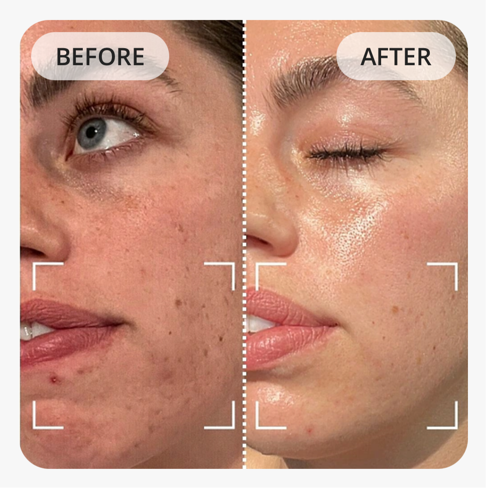 Current Body LED Anti-Blemish Mask: Series 1