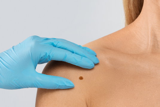 Mole Mapping | Mole Checking & Screening | The Cosmetic Club