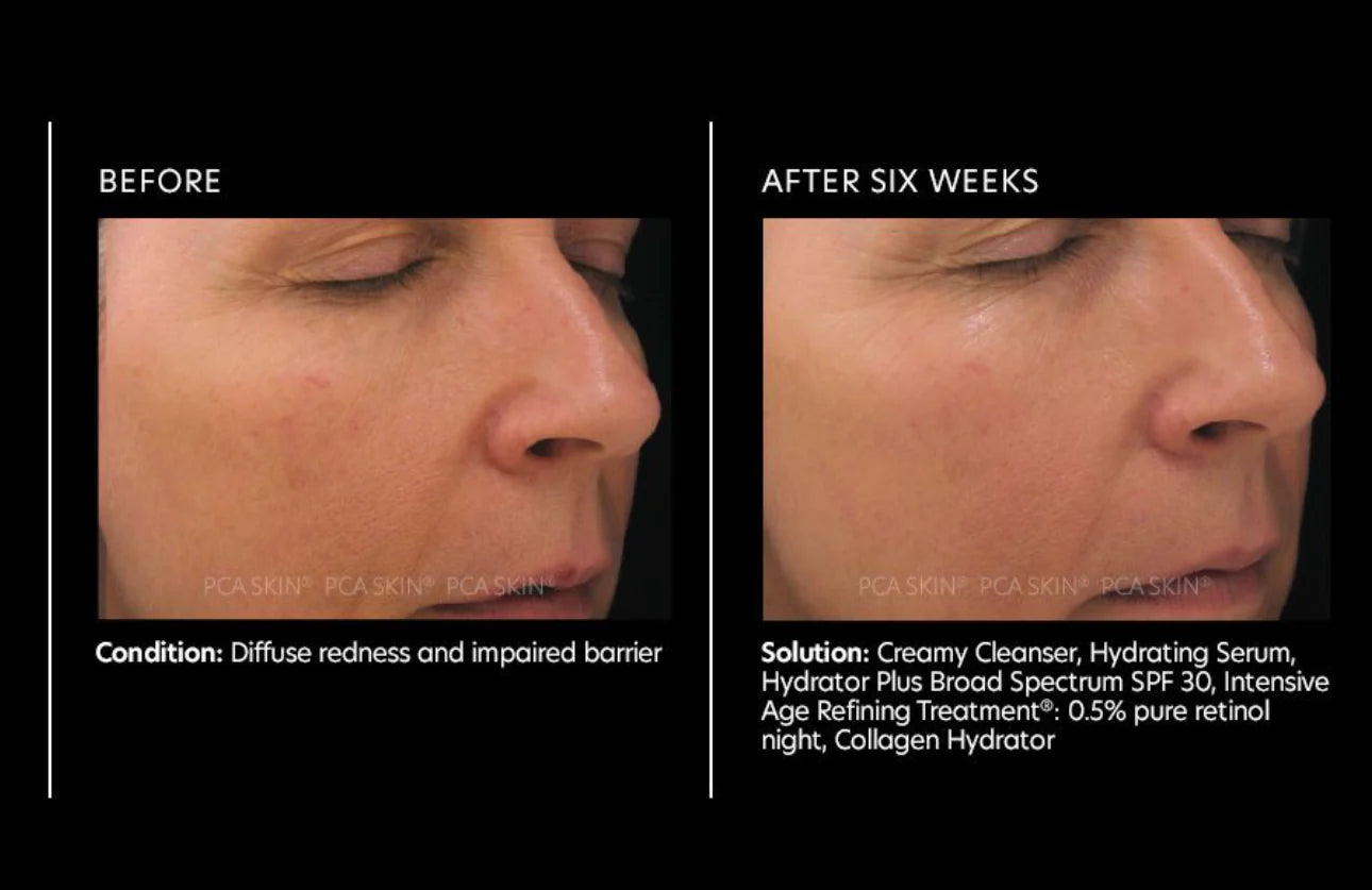 PCA Skin Intensive Age Refining Treatment®: 0.5% Pure Retinol Night 29.5g