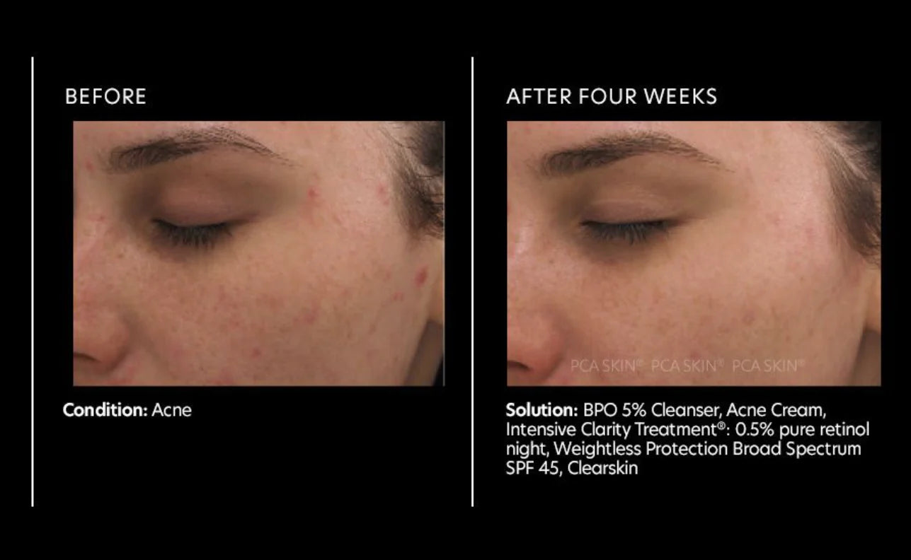 PCA Skin Intensive Clarity Treatment®: 0.5% Pure Retinol Night 29.5g